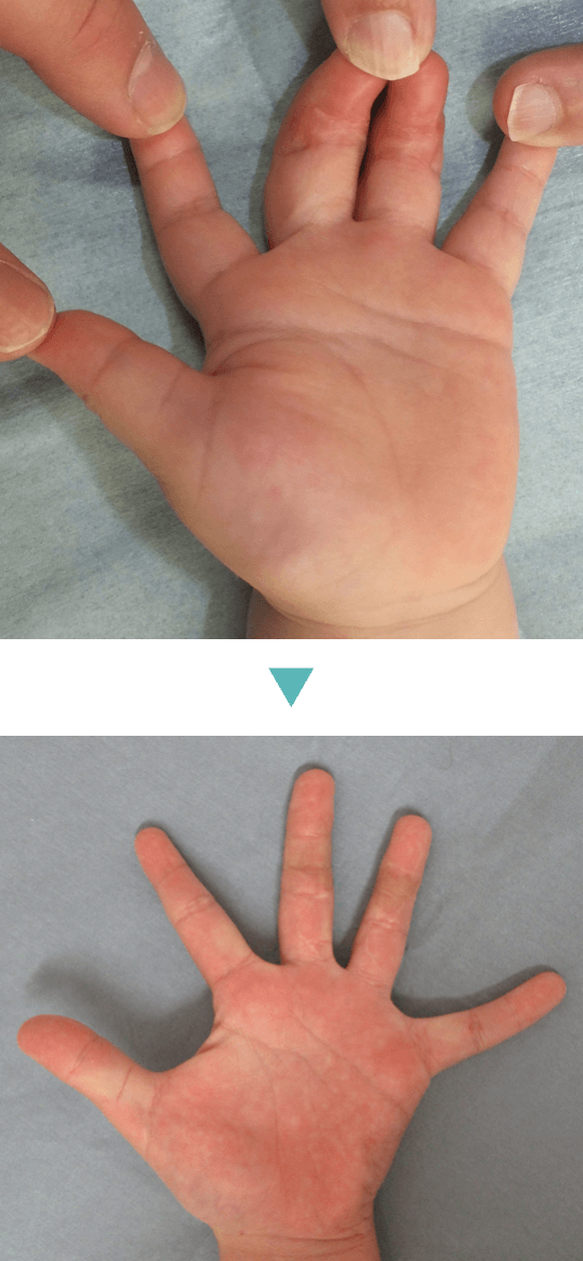 指 を 細く する 整形